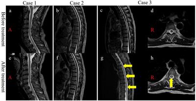 Case report: MRI-negative myelitis following COVID-19 with SEP abnormalities: a case series and literature review